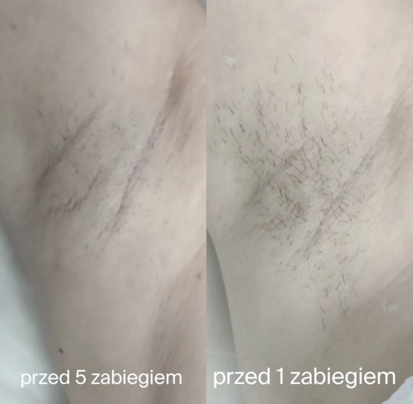 Pachy: porównanie przed pierwszym zabiegiem i przed piątym zabiegiem