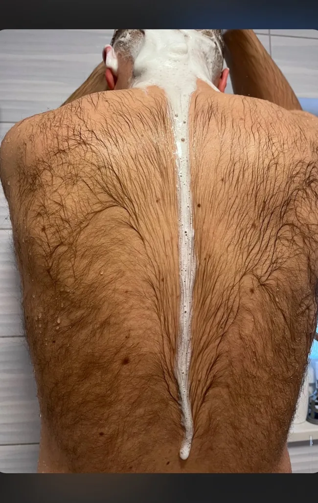 Plecy przed serią epilacji laserowej